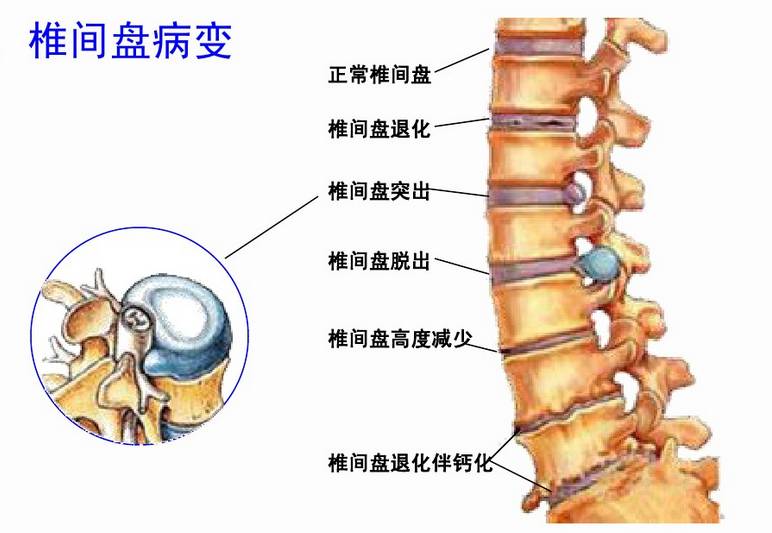 腰间盘突出最新疗法，探索前沿技术与治疗希望